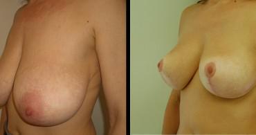 Κάθετη Μαστοπλαστική,6 μήνες μετά